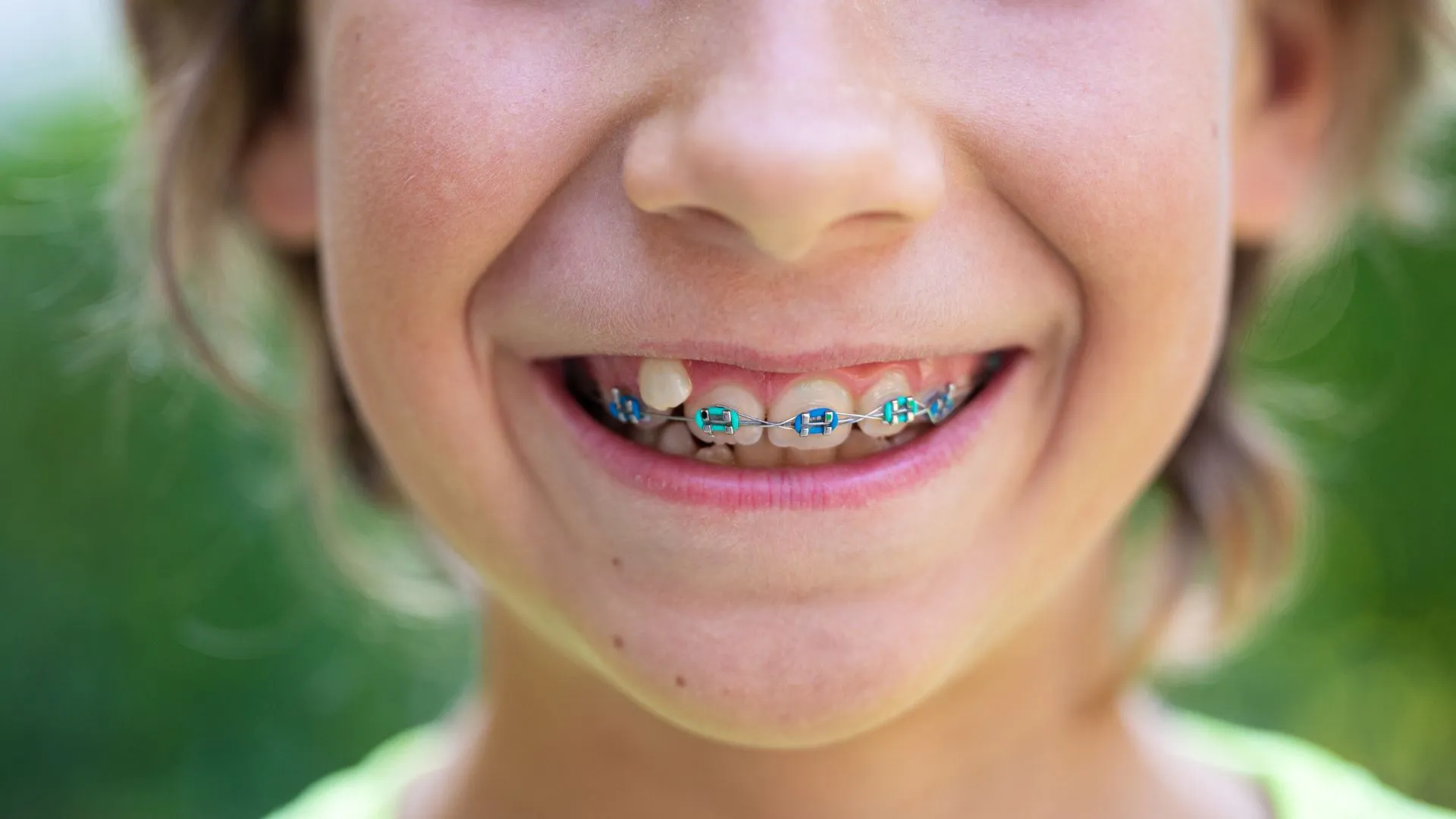 Braces for kids