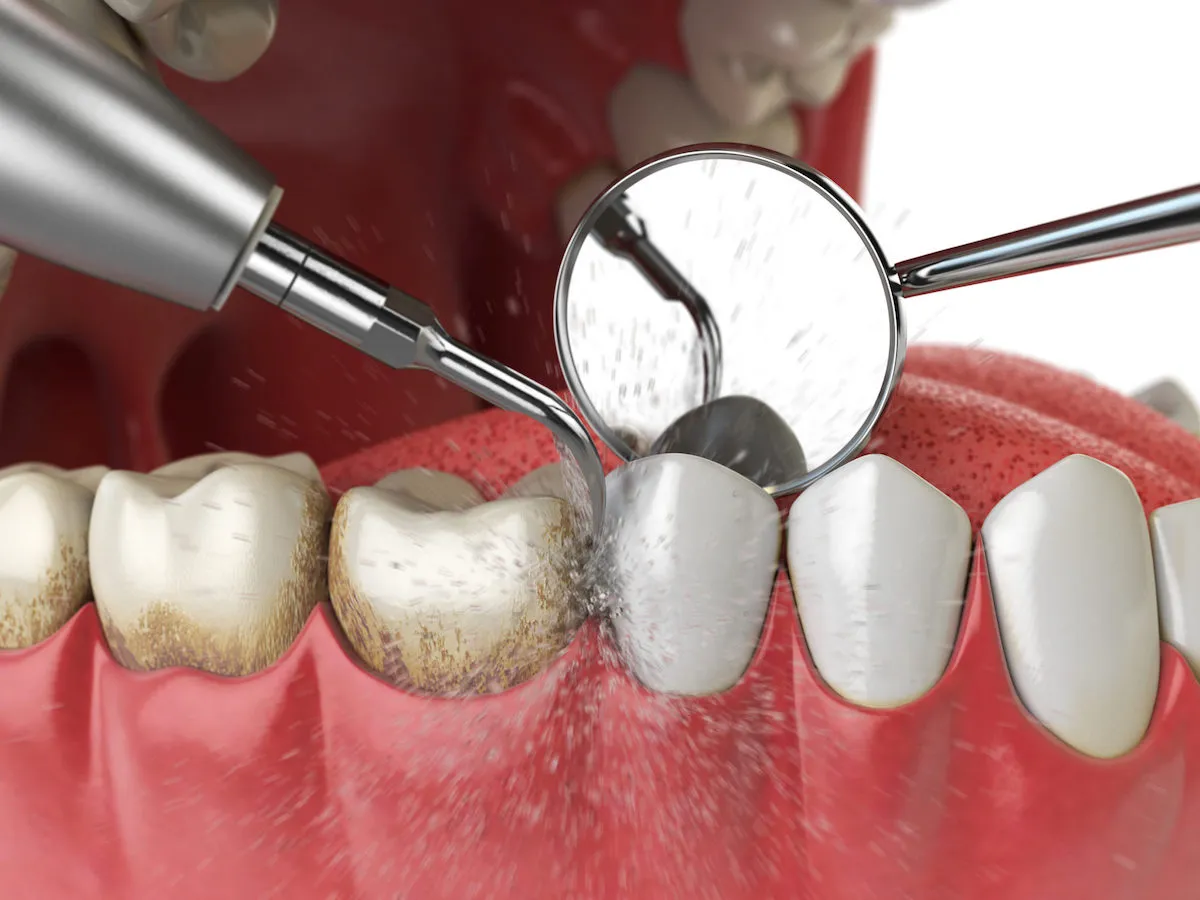 Teeth cleaning special