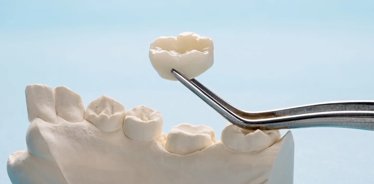 Close-up of a high-quality porcelain dental crown