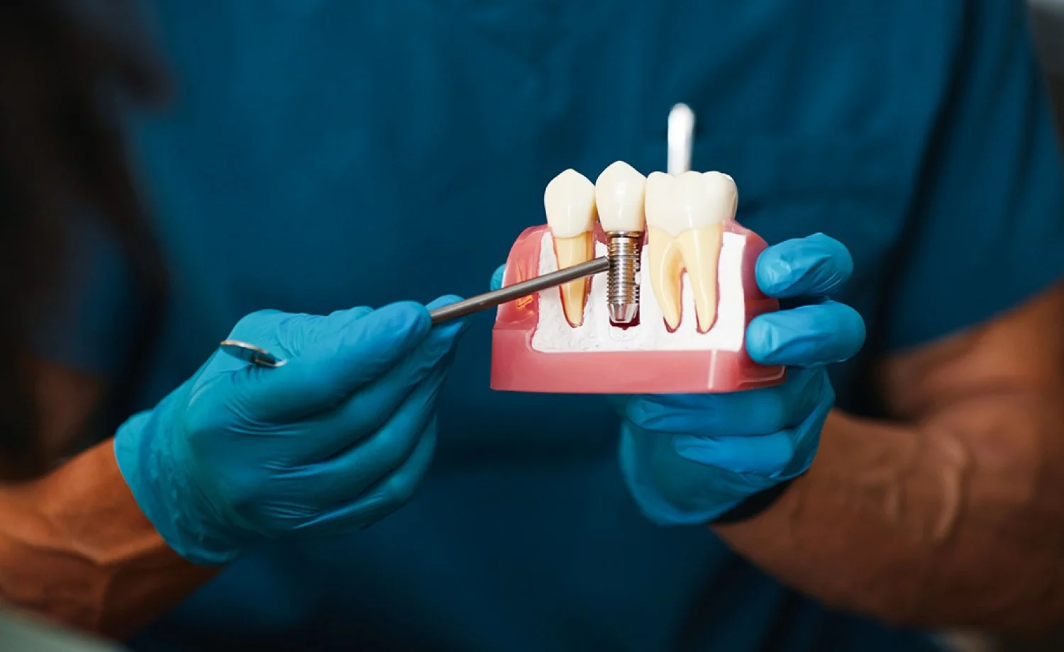 Extreme close up of a perfect radiant smile with high-end Dental Implants showing natural translucency and white aesthetic