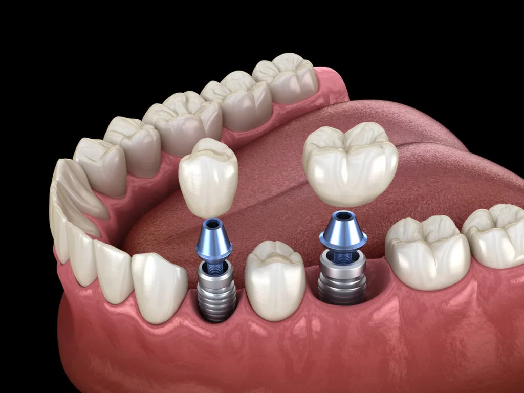 Dental implants offer