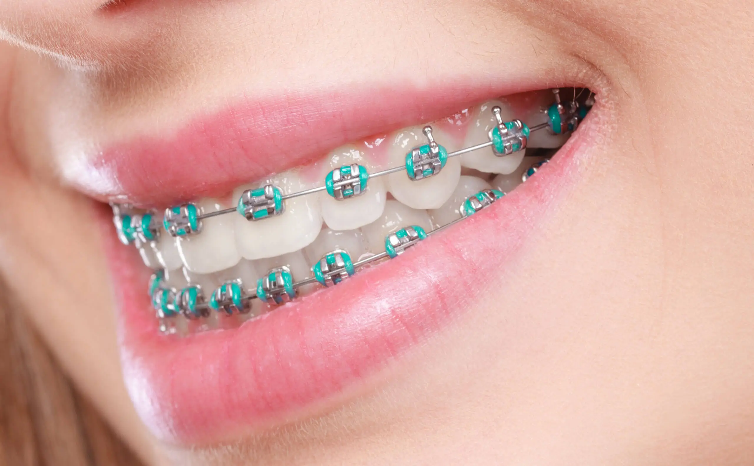 Braces close-up alignment treatment